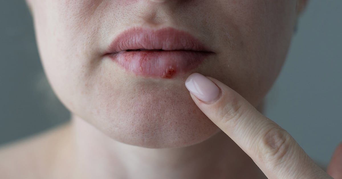 La FDA aprobó un antiviral oral inédito para casos de herpes que no responden a los tratamientos habituales