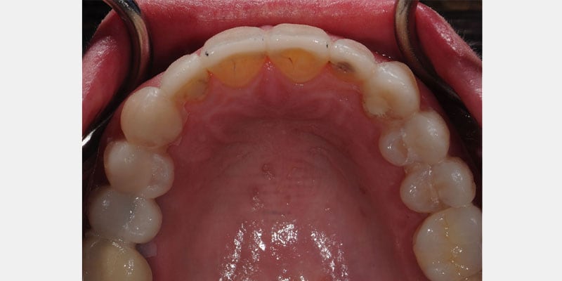 Carillas dentales: la filtración que aparece por debajo y puede costar caro